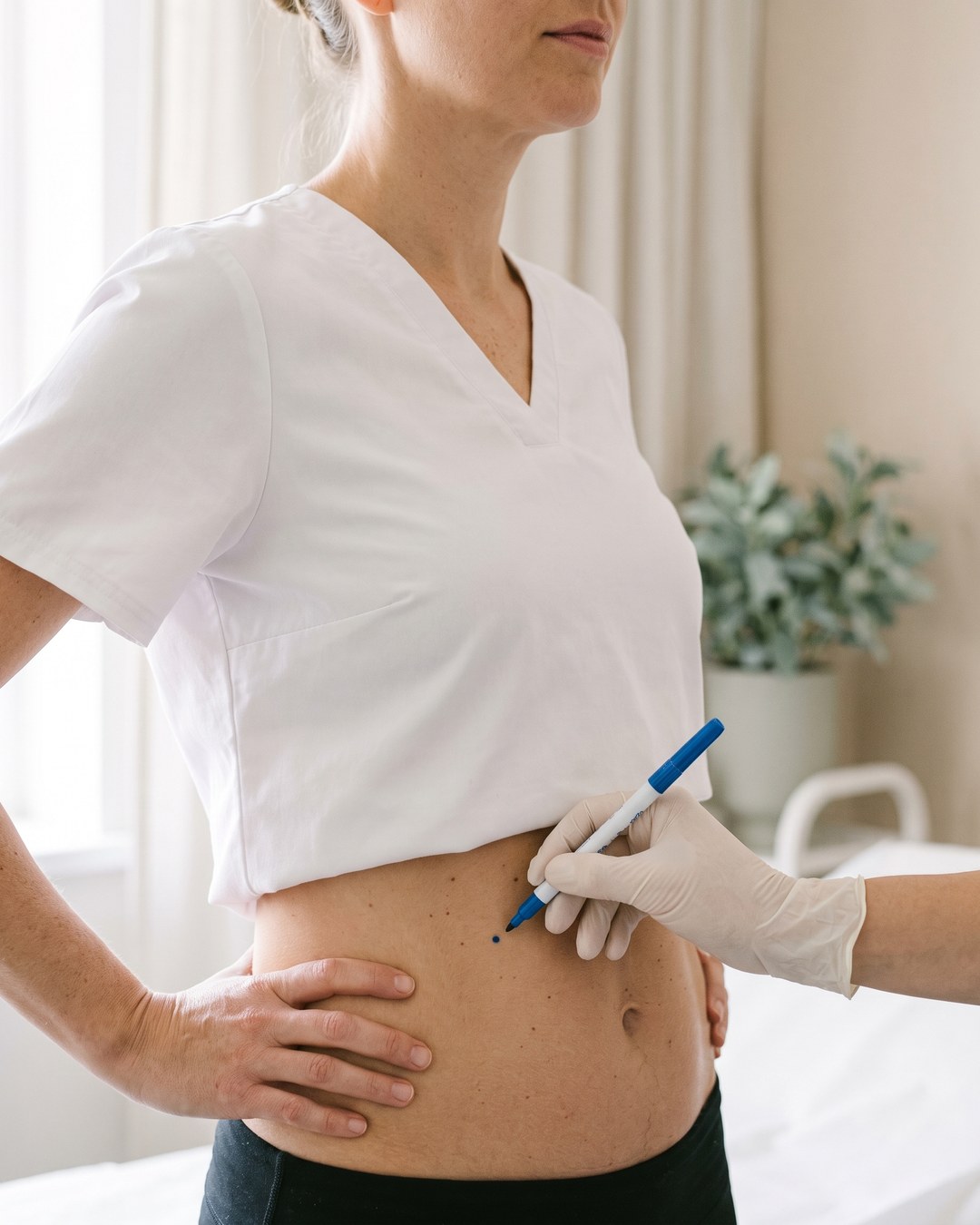 Ergebnis einer Bauch-Fettabsaugung