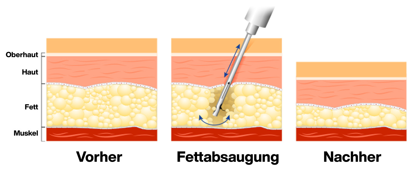 Fettabsaugung Liposuktion: Was passiert mit den Fettzellen