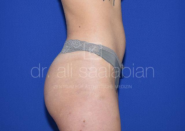 Body Contouring, 20 Vorher-Nachher