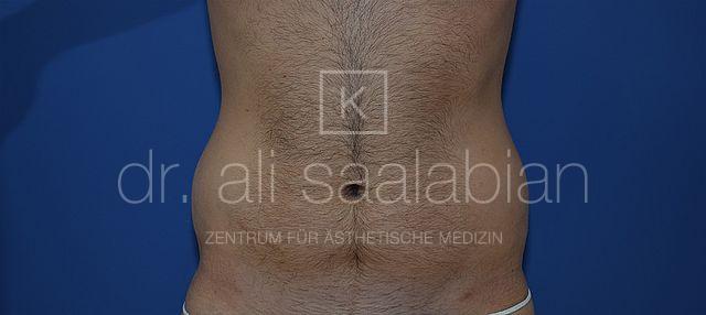Fettabsaugung, 32 Vorher-Nachher