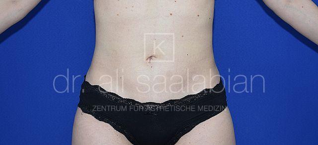 Fettabsaugung, 30 Vorher-Nachher