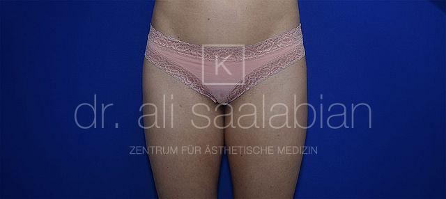 Fettabsaugung, 33 Vorher-Nachher