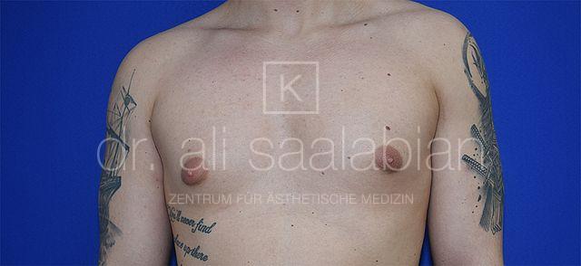 Fettabsaugung, 26 Vorher-Nachher