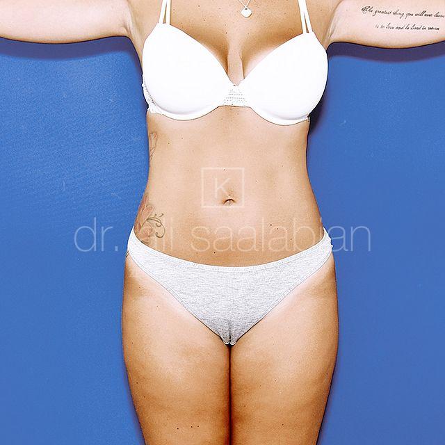 Body Contouring, 26 Vorher-Nachher