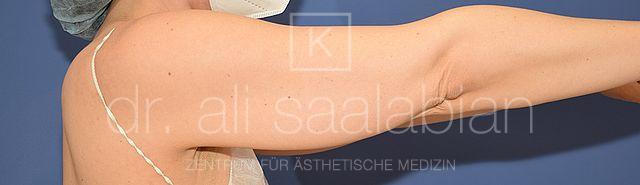 Fettabsaugung, 43 Vorher-Nachher